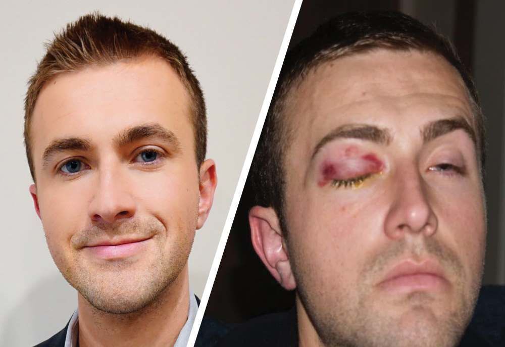 Adam Keup before and after (copy)
